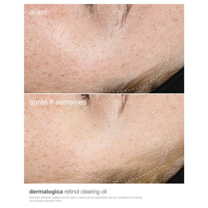 Dermalogica Retinol Clearing Oil - Aceite nocturno antienvejecimiento con ácido salicílico para el acné y la renovación de la piel